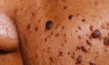 Dermatosis Papulosa Nigra