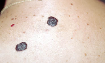 Seborrheic Keratosis