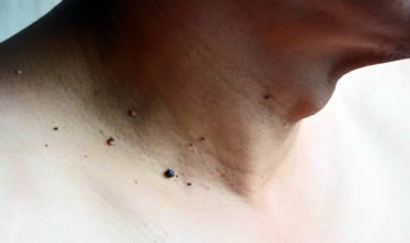 Skin tags