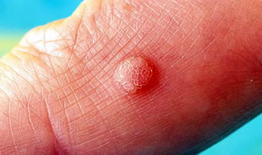Warts