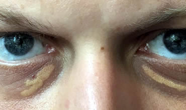 Xanthelasma