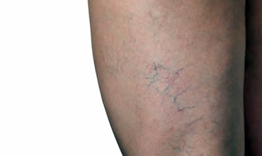 Facial, spider and leg veins