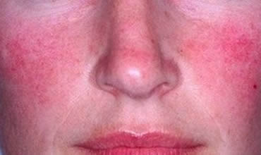 General skin redness