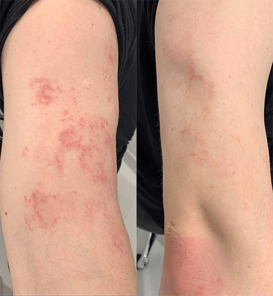 LED light therapy for Psoriasis Before And After