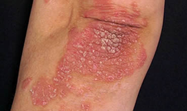 Psoriasis