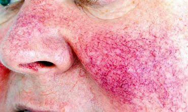 Rosacea